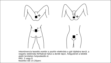 Elektróda felhelyezés